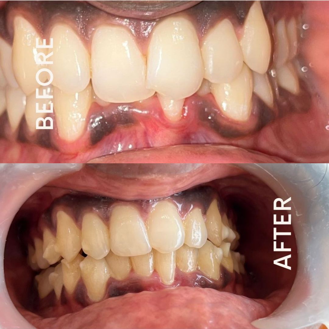 Invisalign - Before and After