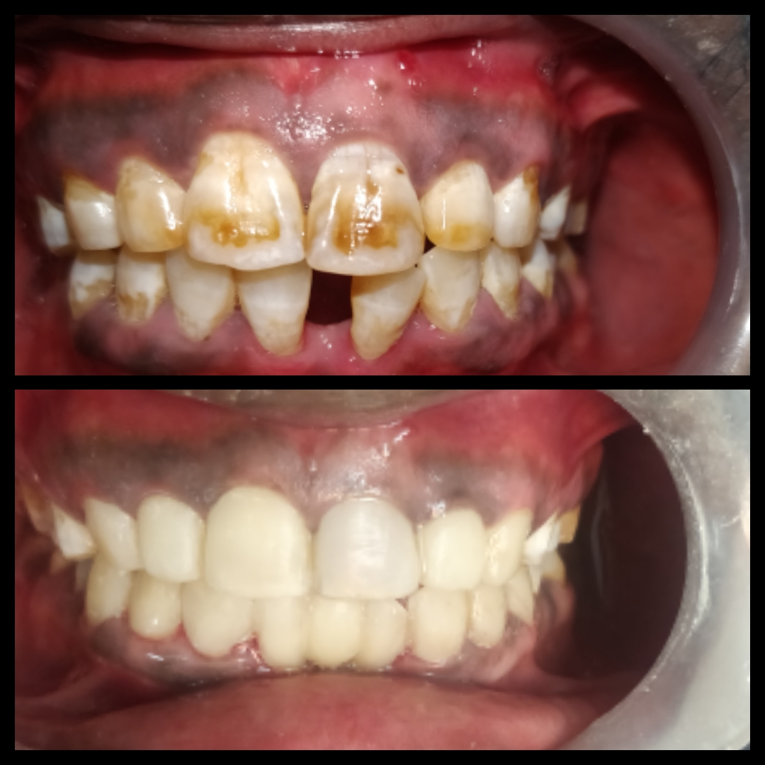 Smile Rehabilitation