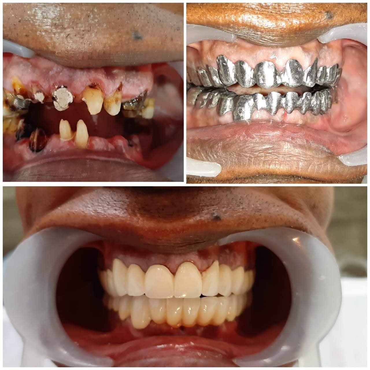 Full Mouth Rehabilitation