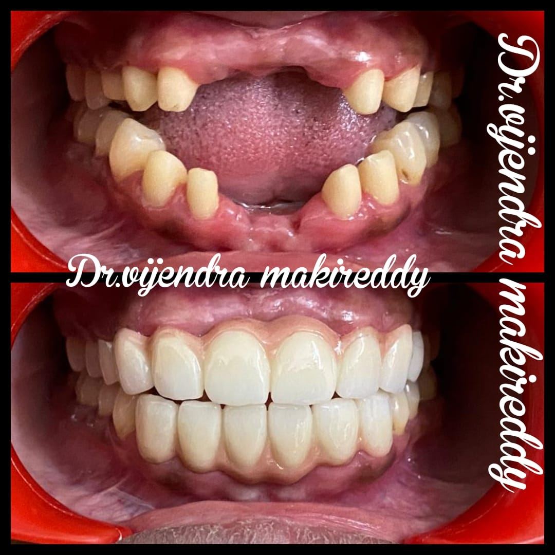 Smile Designing