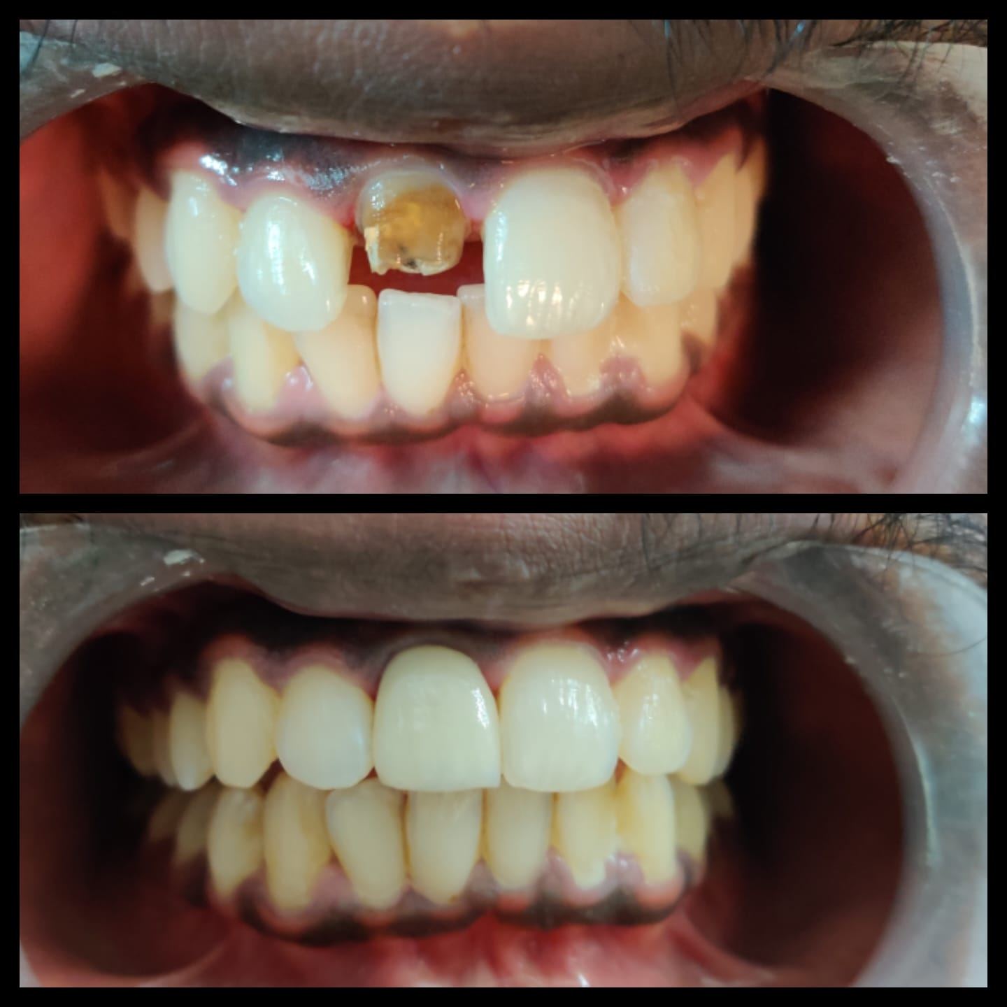 Esthetic Veneers
