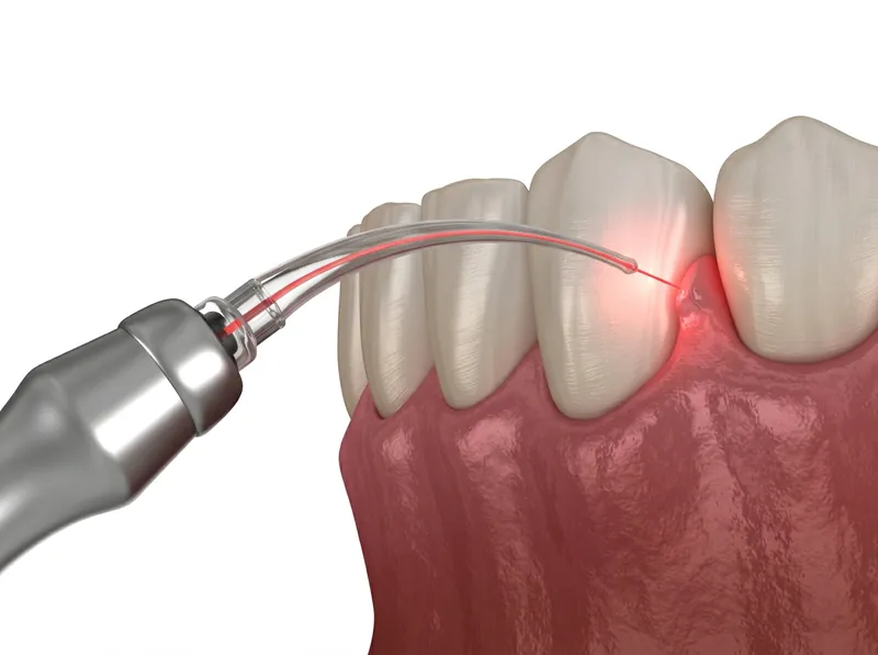 Laser Dentistry