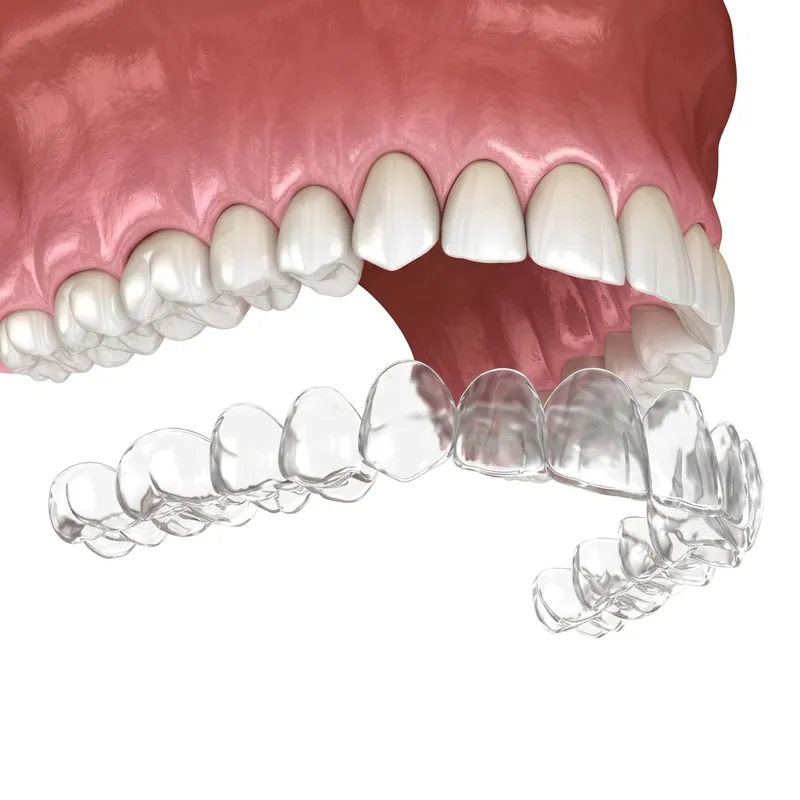 Aligners
