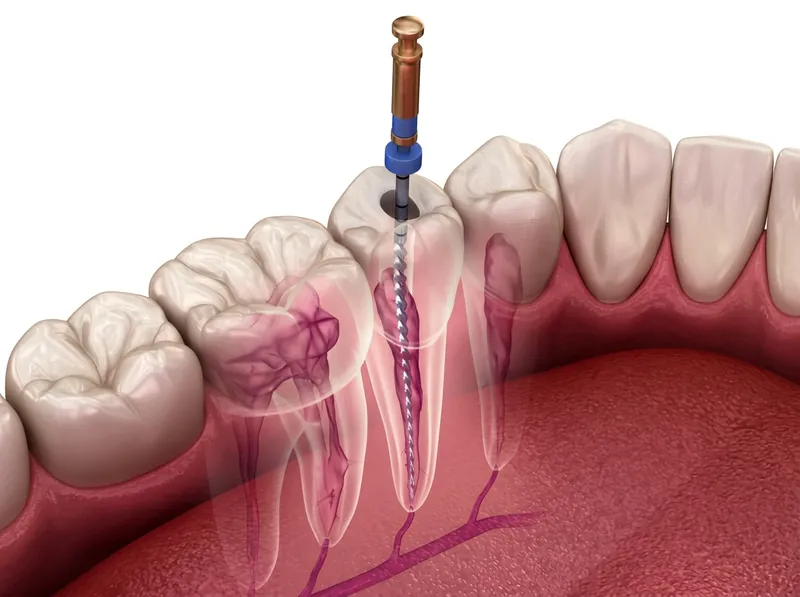 Endodontics